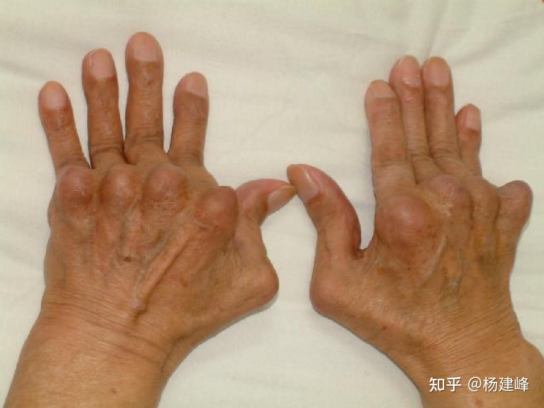 我认为,关节炎症状的出现,或者任何一种关节炎疾病,都是压力积累的