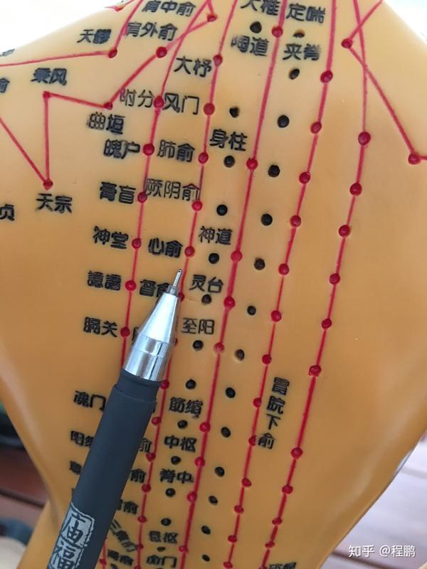 拔罐调理病症之~颈椎病