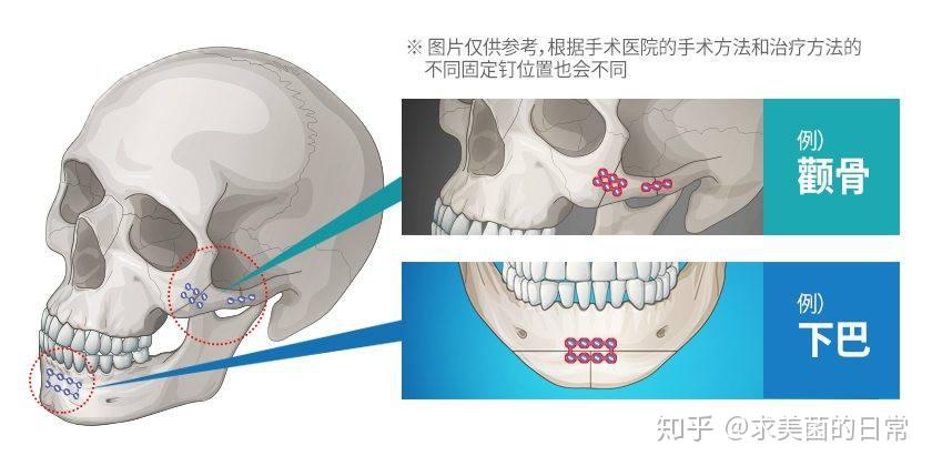 颧骨内推钛钉钛板要不要取出影响生活吗