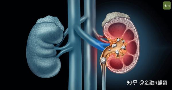 肾结石痛如腰斩肾结石5大症状预防肾结石这样吃