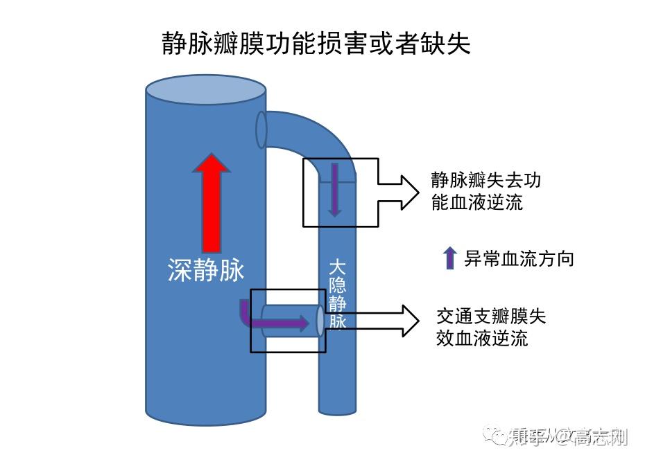 失去静脉瓣的作用,大隐静脉在站立的时候要承受下半身高度以上的巨大