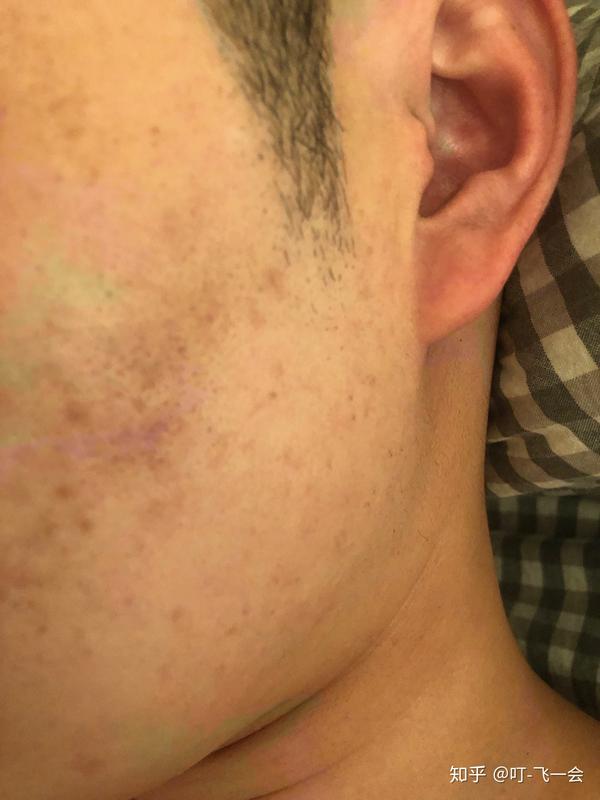 脸上以前得过扁平疣好了留下的色素沉着如何治疗