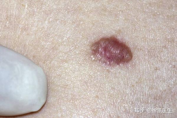 日常科普:常见的皮肤癌有哪些?