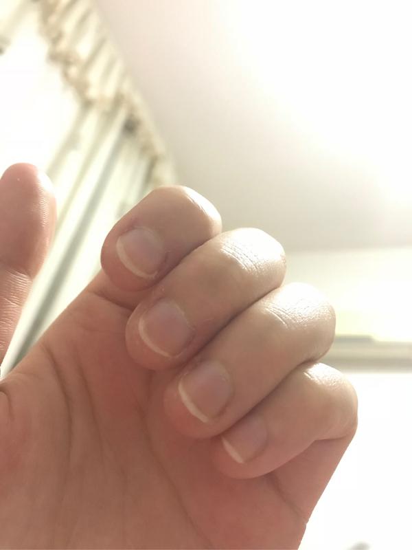 甲床过短应该如何变长?
