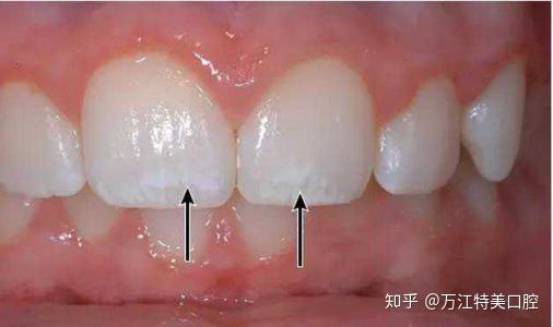 不少宝宝牙齿很整齐,可是牙齿上偏偏出现了白的斑点,它是龋齿吗?