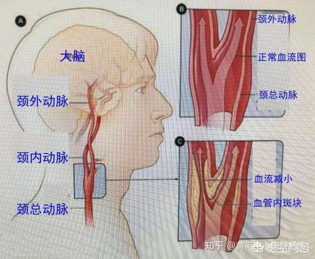 众所周知,颈动脉是供应脑部血液最主要的大动脉,供应着脑部大约三分之