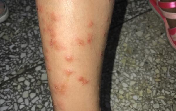 原来去了南方旅游,那就极可能是蠓虫(俗称小咬)叮咬的蠓虫皮炎. 2.