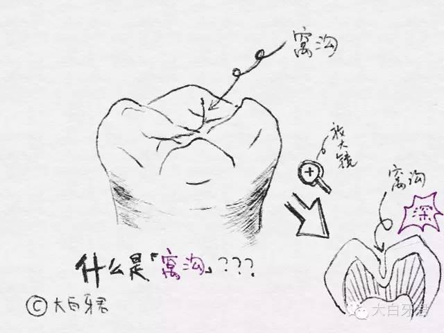 窝沟封闭知多少
