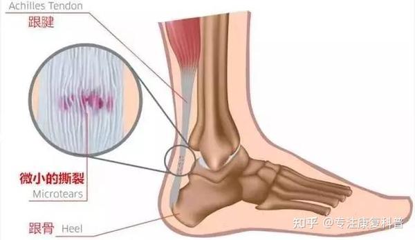 (二) 病因 当跟腱在短时间内承受的压力过大时,可能会发生劳损,细微