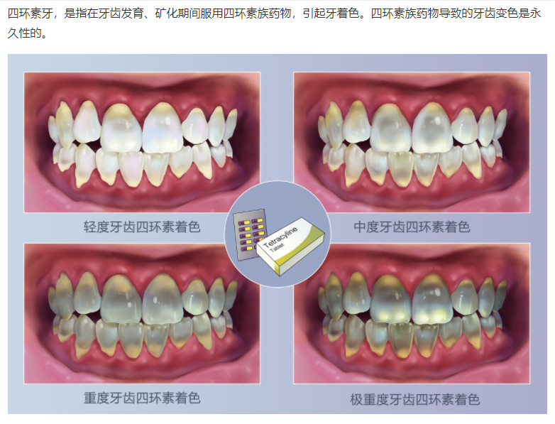 如四环素沉积在牙本质内,就会使得牙齿变成黄色,棕色或暗灰色,称为