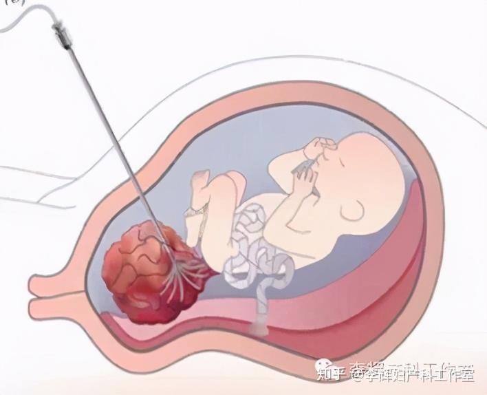 镜技术:是应用超声定位后用直径很细的光学纤维内镜经母体腹壁穿刺,经