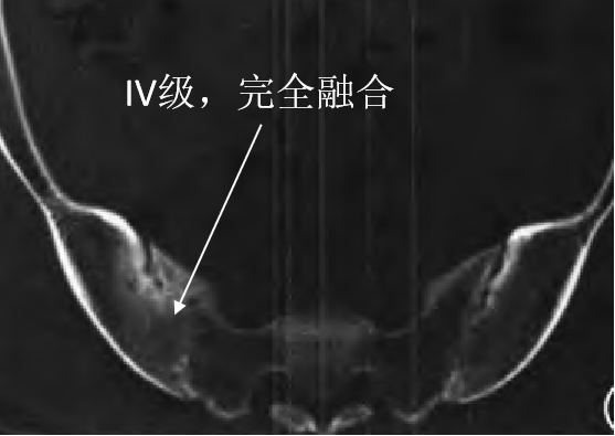 【强直性脊柱炎】骶髂关节炎,级别越高,强直越重?