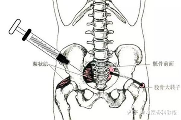 导致「屁股疼」的凶手——梨状肌综合征,应该如何治疗