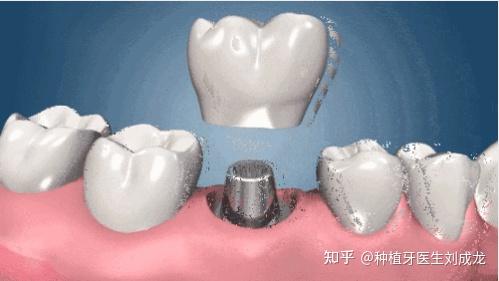 郑州种植牙医生刘成龙:磨牙区单颗种植案例