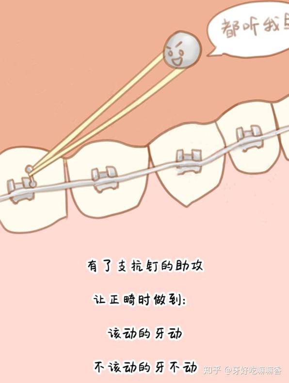 牙齿矫正为什么要打支抗钉?