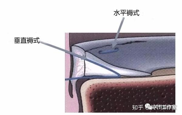 垂直褥式缝合更加牢固