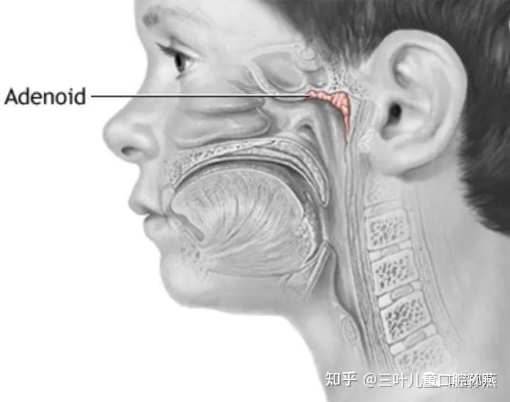 父母需要关注的儿童颜值杀手腺样体面容