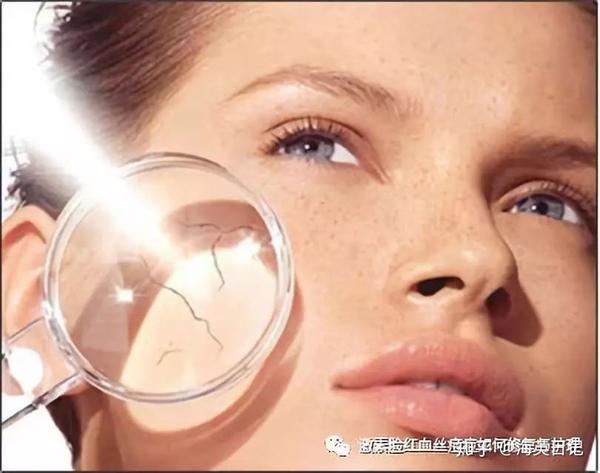 海英:什么是晒斑?如何防治?