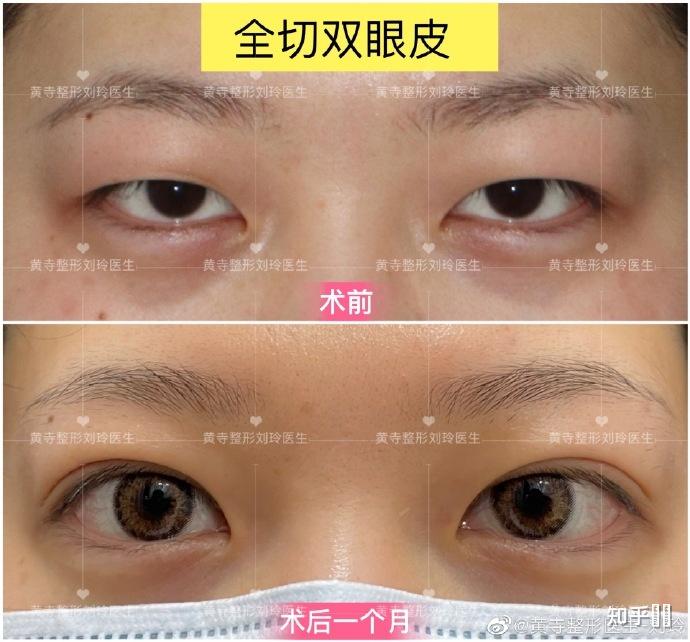 内双或扇形双眼皮可以有多好看?