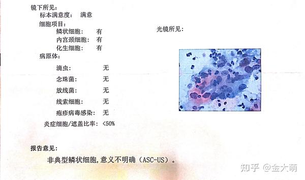 低级别鳞状上皮内病变,注意这个时候还没有查出hpv高危型16,18型感染