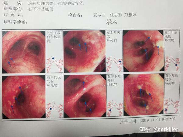 支气管镜手术过程