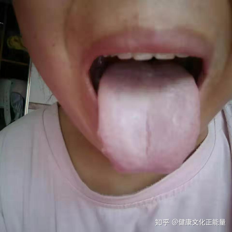 你是最严重的早泄吗脾肾阳虚的舌苔一眼便知