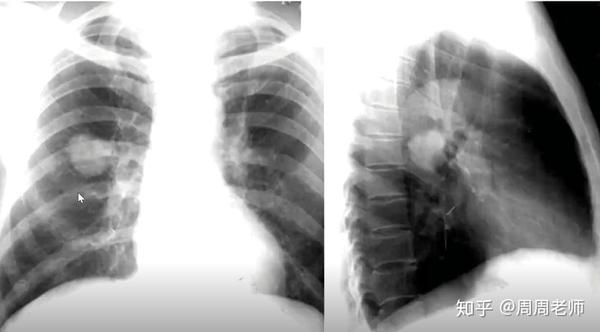 胸片(右侧中央型肺癌)
