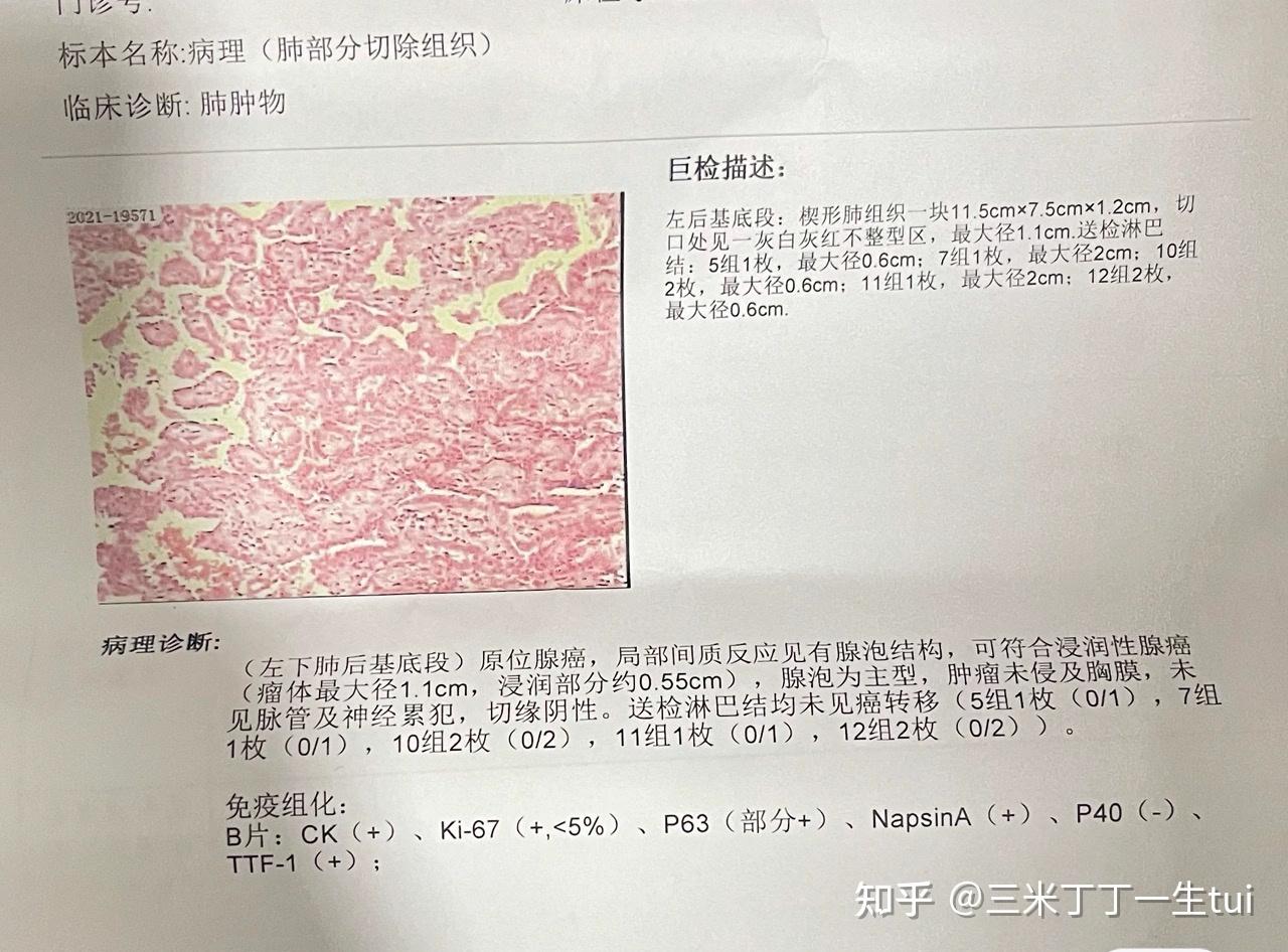 母亲57岁,浸润性肺腺癌