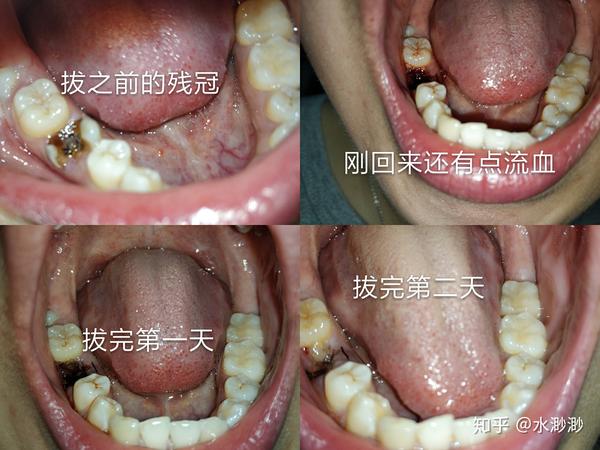 深圳根管治疗 补牙 拔牙经历