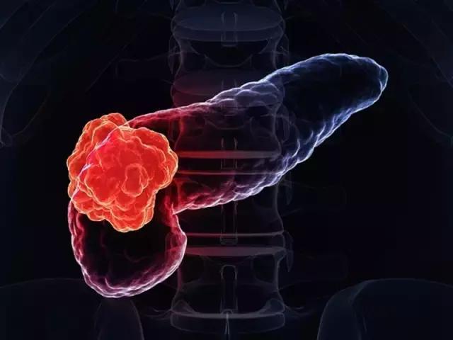 研究人员发现了一种可能代表胰腺癌更安全治疗靶点的蛋白质