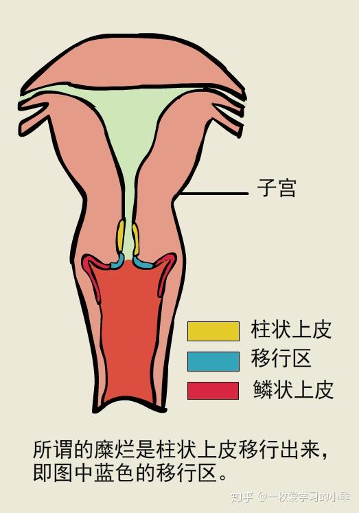 所以,从本质上说,所谓的宫颈糜烂,实际上是柱状上皮外翻.