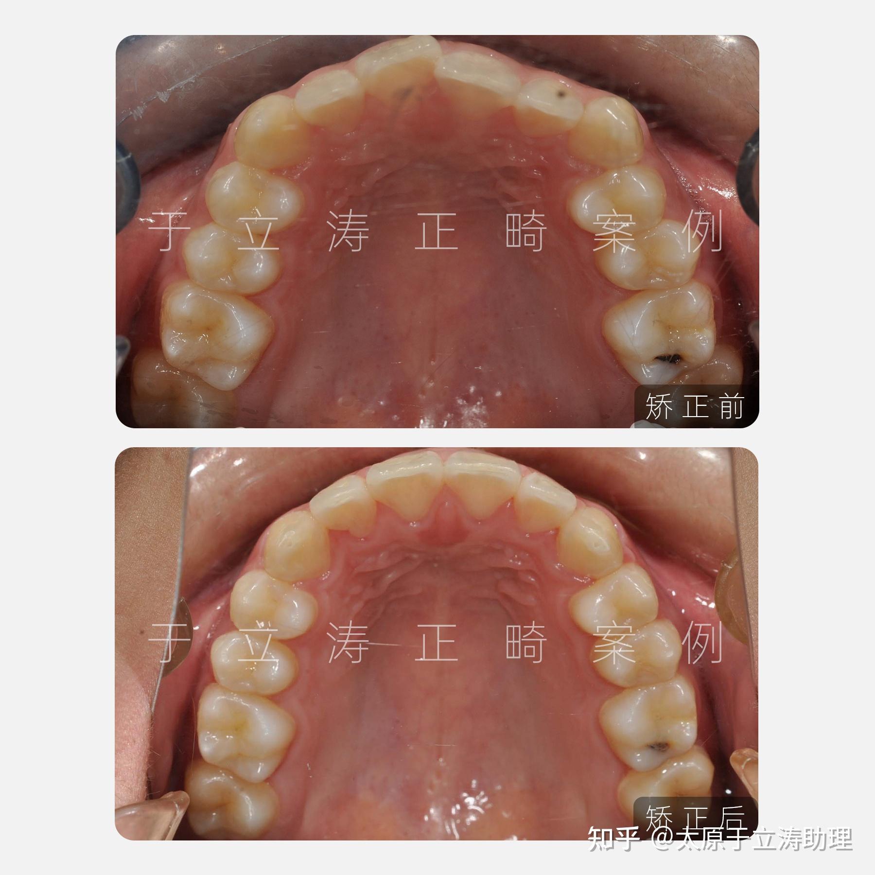 太原牙齿矫正|牙列拥挤 牙齿前突怎么办?