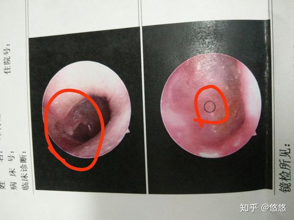 慢性,化脓性中耳炎,鼓膜大穿孔一年自愈经历