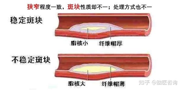 斑块易损程度越重,越易发生斑块脱落,在血流比较缓慢区域越易堵塞血管