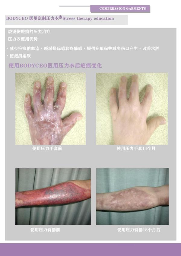 一般认为,对增生性瘢痕应采用压力疗法和硅胶凝胶联合治疗,以提高治疗