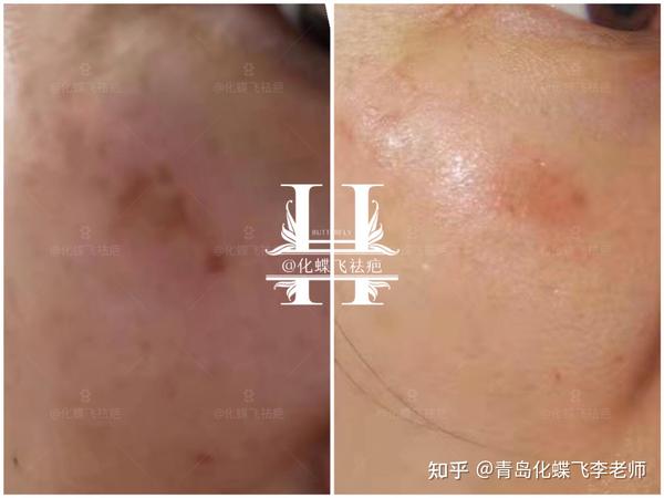 擦伤,磕伤,烧烫伤,激光术后回流色素疤痕
