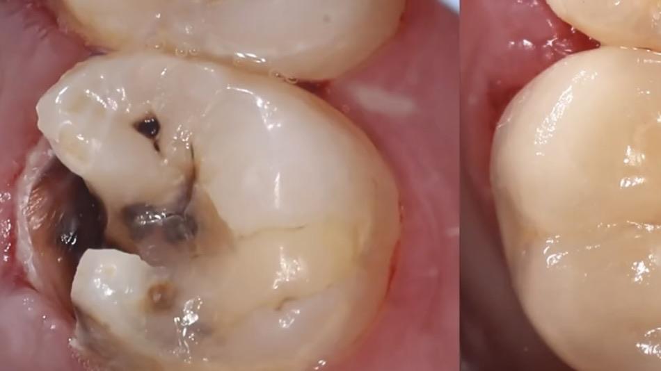 有谁做过牙齿 根管治疗,疼不疼?