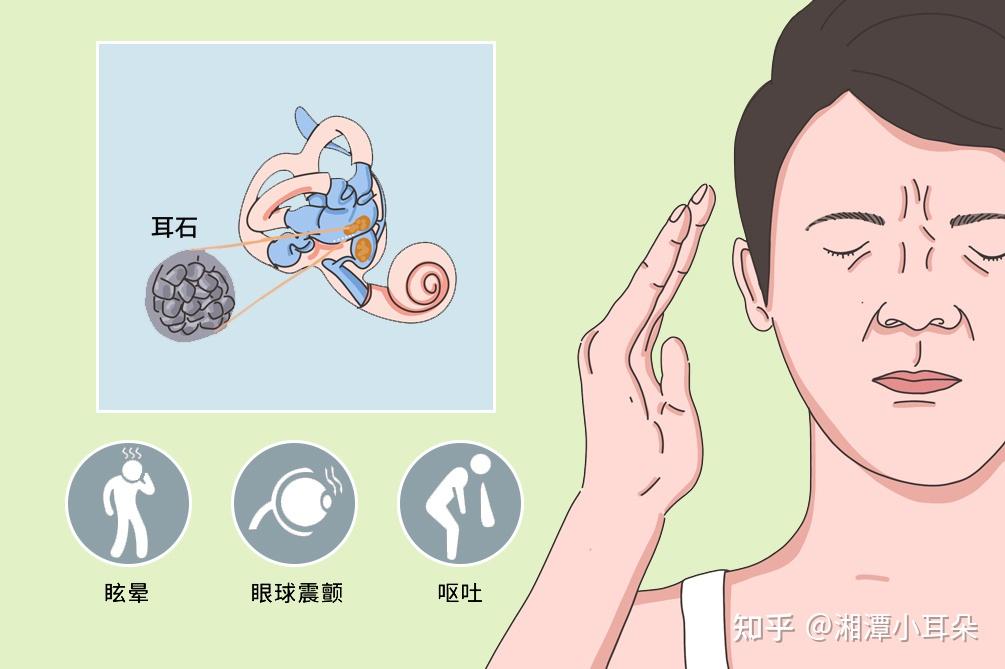 耳石症又称为良性阵发性位置性眩晕(bppv),是指头部运动至某一特定头