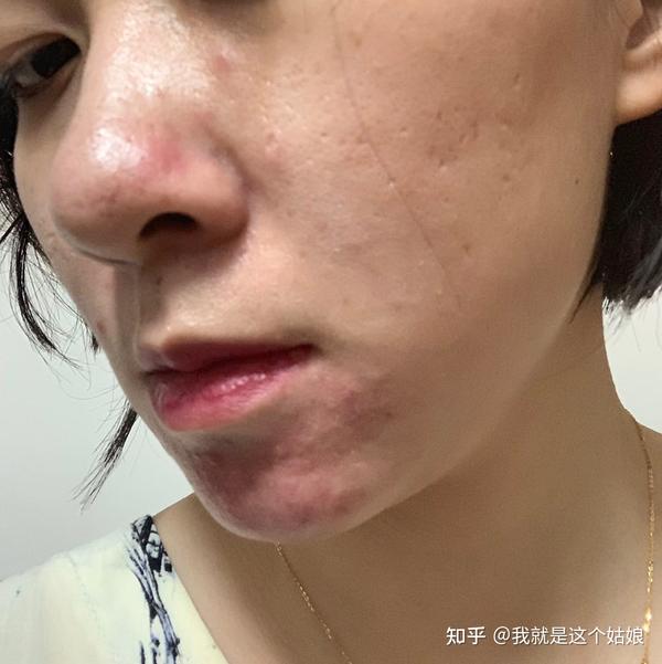 玫瑰痤疮脂溢性皮炎4年治疗分享