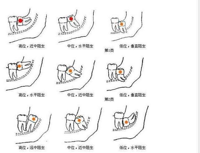 您的智齿需要拔除么拔智齿影响智商么