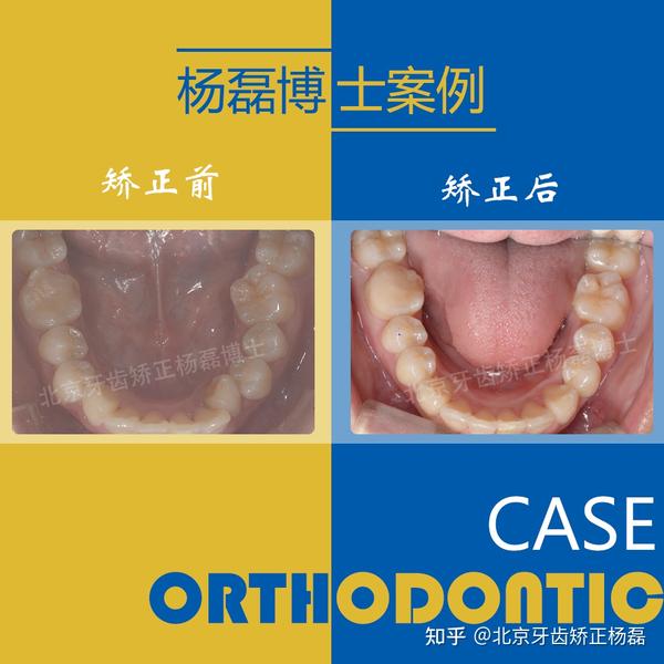 隐形矫正纠正严重深覆颌具有一定的难度,因此设计了前牙平导板辅助