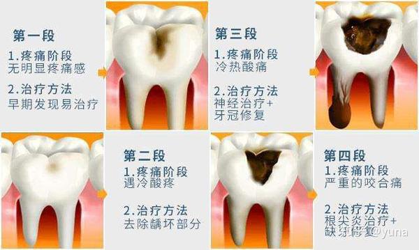 2.乳牙也是牙 龋坏要及时治