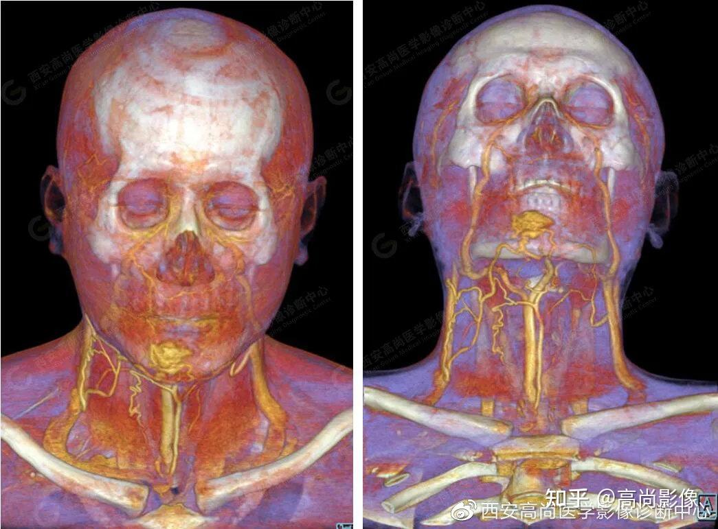 西安高尚病例颌面部血管畸形ctactv成像技术应用