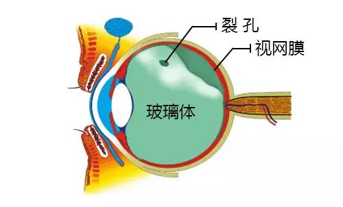 飞蚊症:玻璃体后脱离会自愈吗?