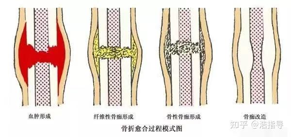 其中,骨组织的愈合大致可分为三期:血肿机化期——这个时期主要是以