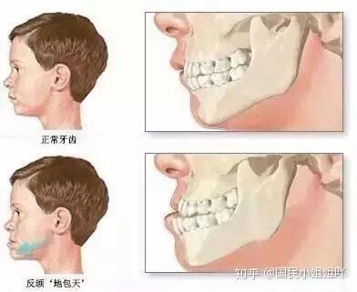 吮指 奶瓶喂养 口呼吸 儿童牙齿矫正第一个最佳时期 乳牙期(可避免