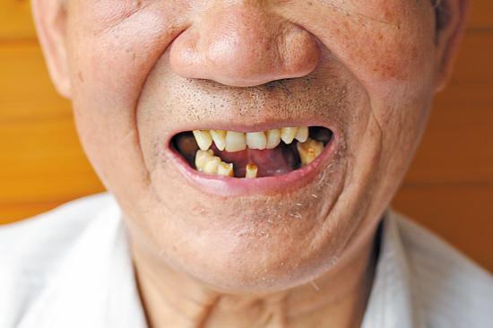 牙齿缺失补救方法有哪些?