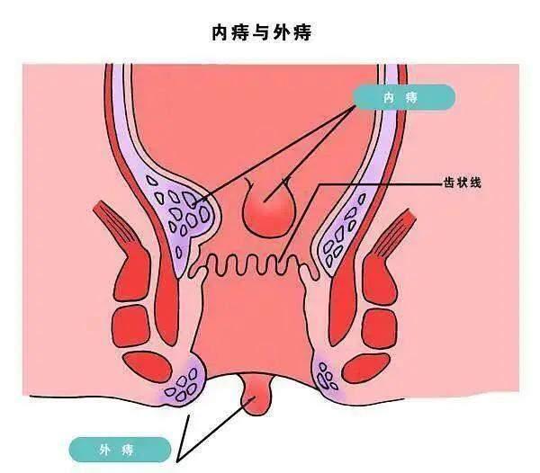 "内痔"和"外痔"以齿状线为界划分