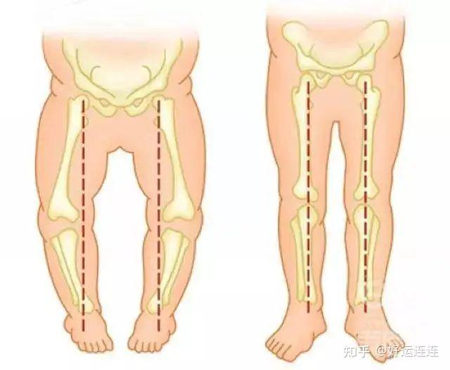 好孕妈妈月嫂提醒宝宝o型腿这个谣言宝妈千万别信