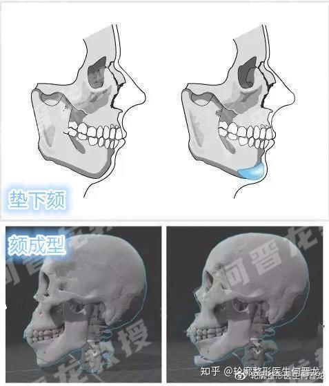 颏成型与假体垫下巴:垫下巴并不是"最优解"